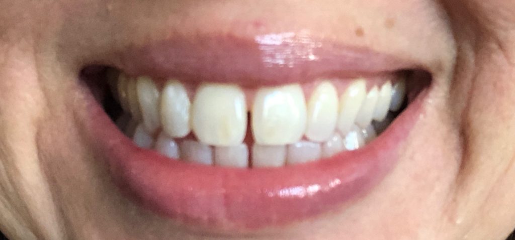 Before Teeth Whitening Kit Deb
