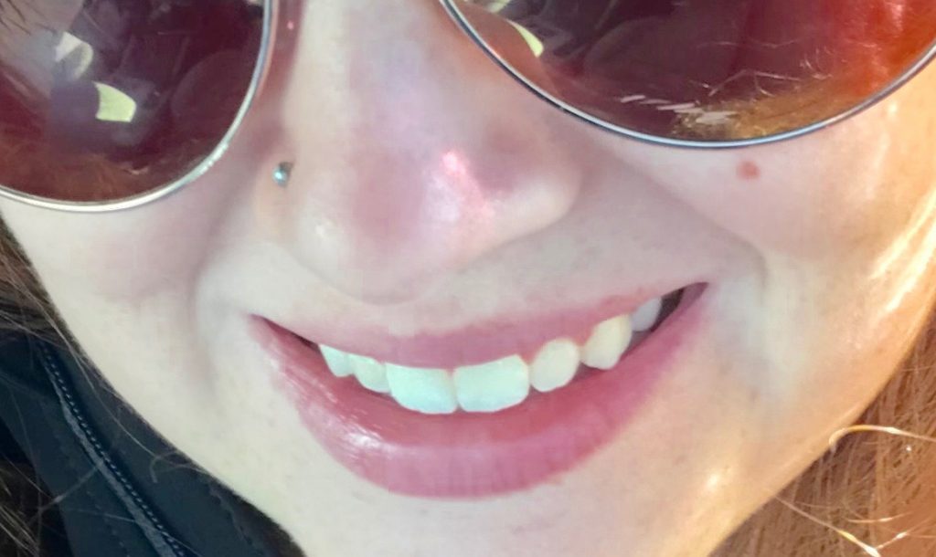 Emma After Teeth Whitening 
