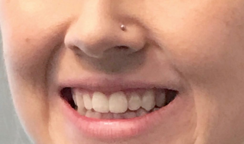 Before Teeth Whitening Kit Emma